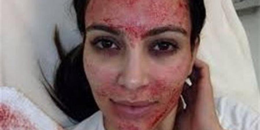 ما هي تقنية مصاص الدماء التجميلية؟ - الآن نيوز