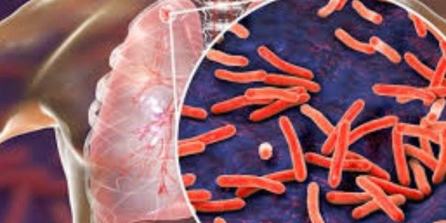 بعد ظهوره في أمريكا .. 7 معلومات عن مرض السل ـ موقع الآن نيوز