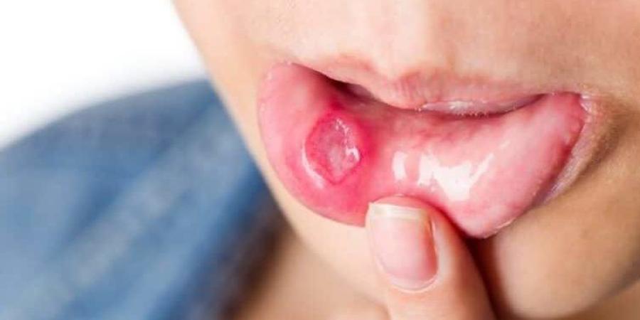 نشرة المرأة والمنوعات| تقرحات الفم أبرز علامات نقص فيتامين B12.. أسباب نحافة الوجه وطرق علاجها ـ موقع الآن نيوز